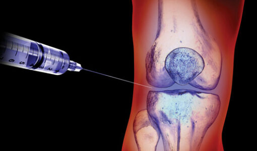 Needle injecting gel into xray of Knee