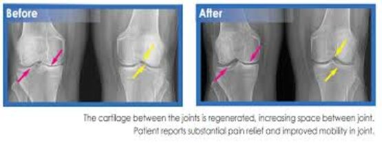 Knees before and after Stem Cell treatment