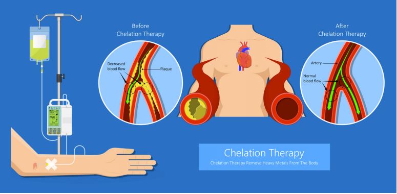 Drawing or artery before and after IV chelation therapy