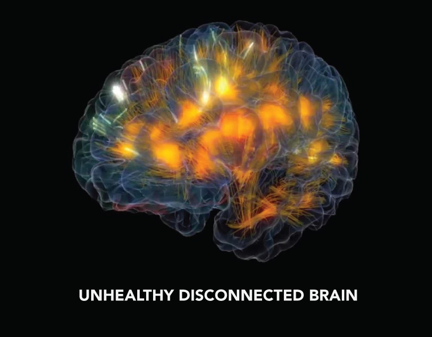 Healthy-disconnected-brain