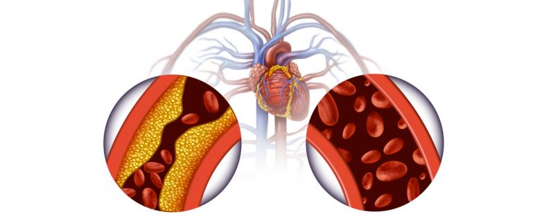 Drawing of Clogged artery and cleared artery