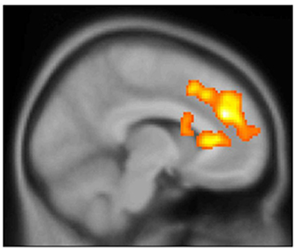 Ketamine boosts bipolar patients' brain activity