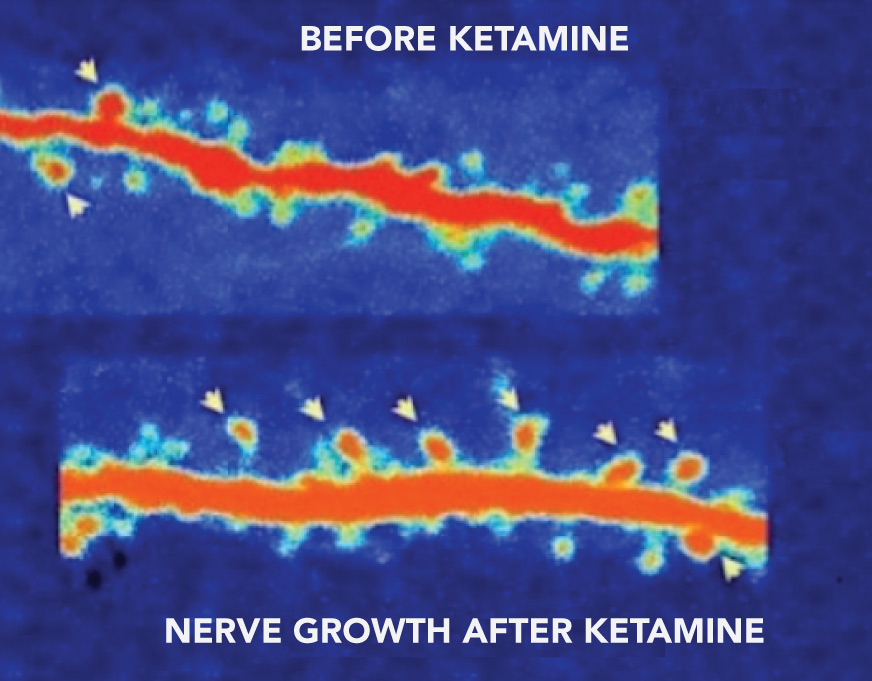 Nerve growth before and after Ketamine Treatment