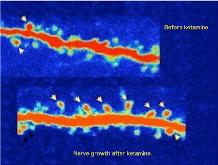 Pet scan nerve growth before and after Ketamine