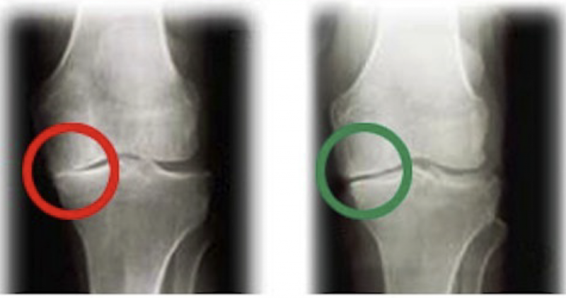 Xray of knee with osteoarthritis reversed