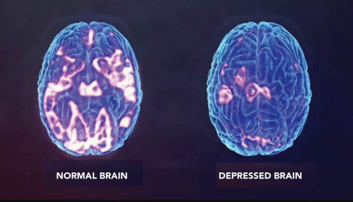 Contrast of normal brain with highlighted parts and depressed brain with very little highlighted parts