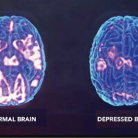 Contrast of normal brain with highlighted parts and depressed brain with very little highlighted parts