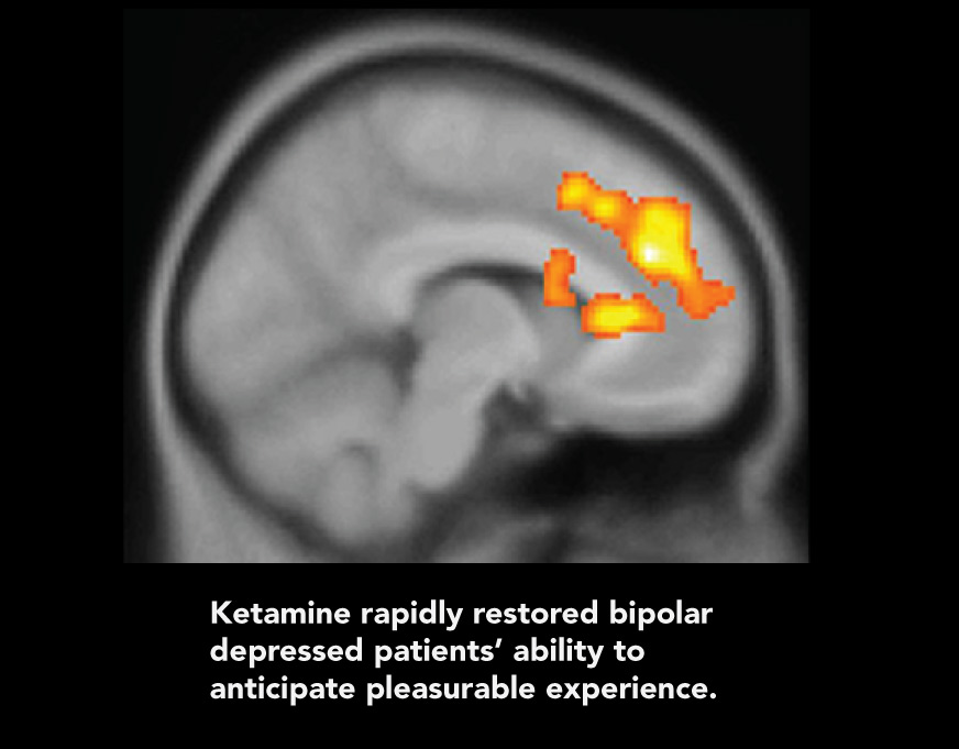 Pet Scan of brain with frontal lobe highlighted