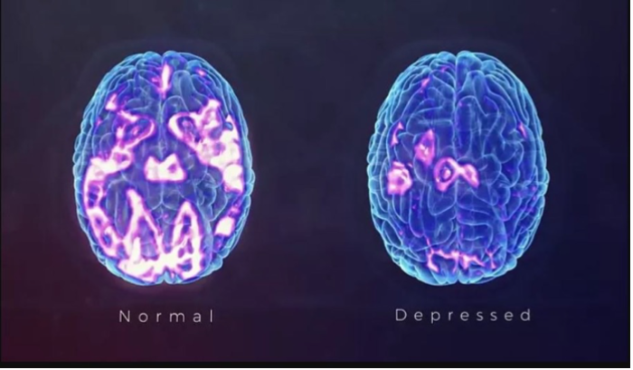 Ketamine stimulates growth of nerves and nerve connections