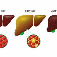 Liver disease. Healthy, fatty and cirrhosis of the liver. liver cells (hepatocyte) image