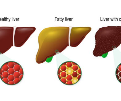 Liver disease. Healthy, fatty and cirrhosis of the liver. liver cells (hepatocyte) image
