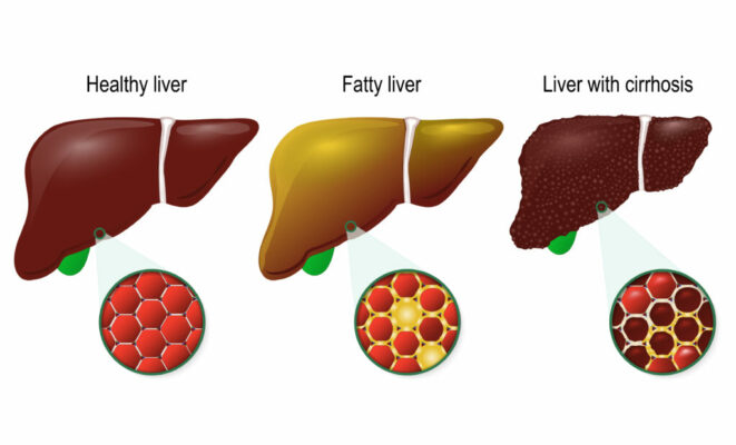 Liver disease. Healthy, fatty and cirrhosis of the liver. liver cells (hepatocyte) image