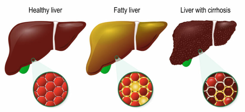 Liver disease. Healthy, fatty and cirrhosis of the liver. liver cells (hepatocyte) image