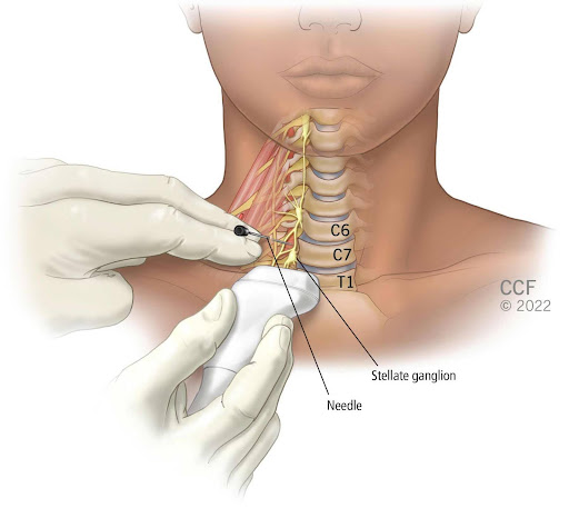 Illustration of Dr administering Stellate Ganglion Block to Patient